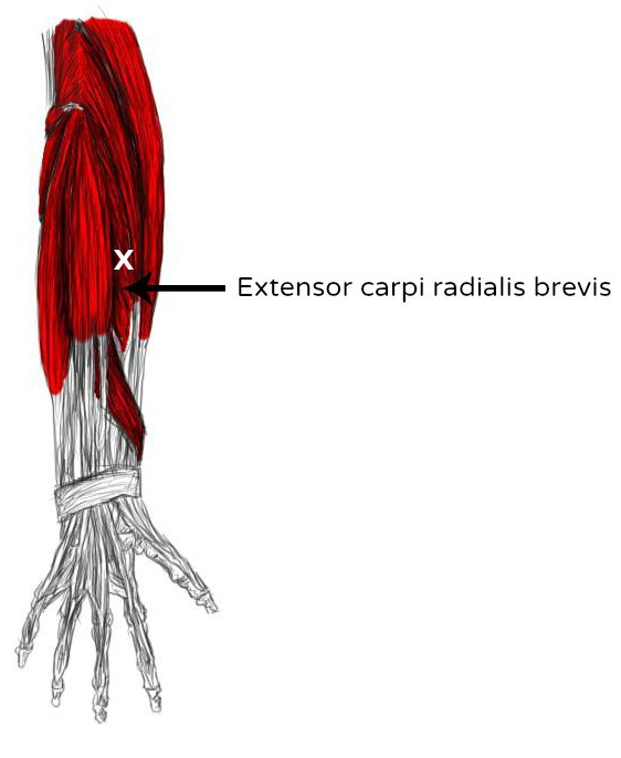 Extensor carpi radialis brevis Schmerzen und Triggerpunkte selbst behandeln