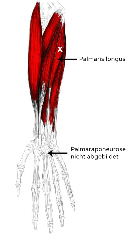 M. Palmaris longus Schmerzen & Triggerpunkte