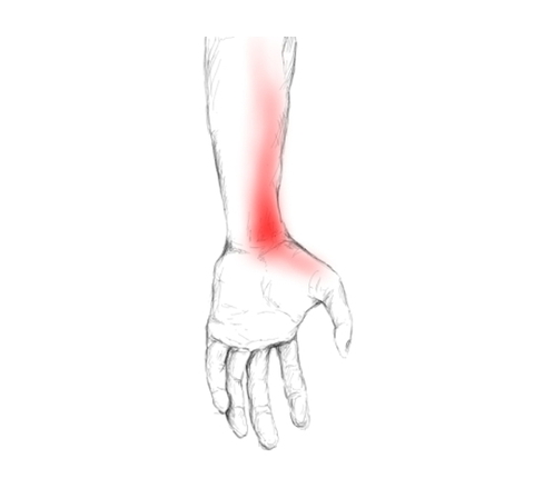 pronator teres schmerzen trigger triggerpunkte behandeln unterarmen muskel