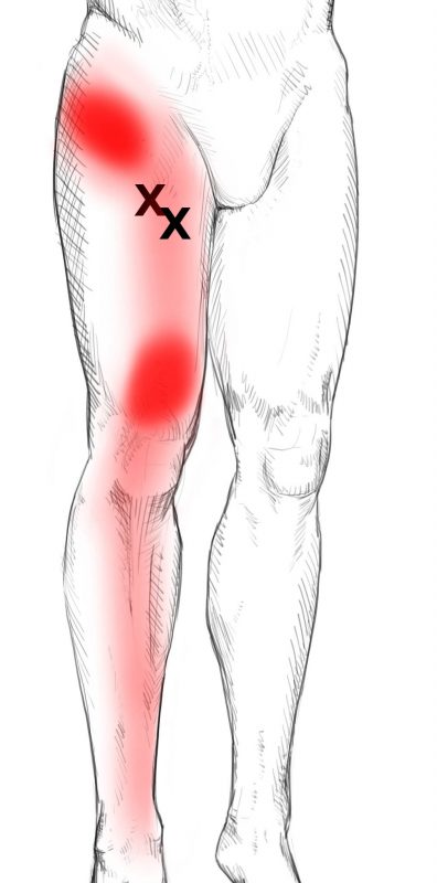 schmerzen im linken bein wie muskelkater - www.listaso.com.