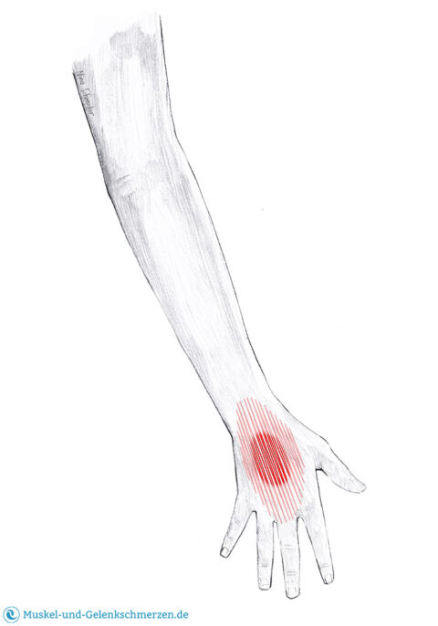 Extensor carpi radialis brevis Schmerzen und Triggerpunkte selbst behandeln