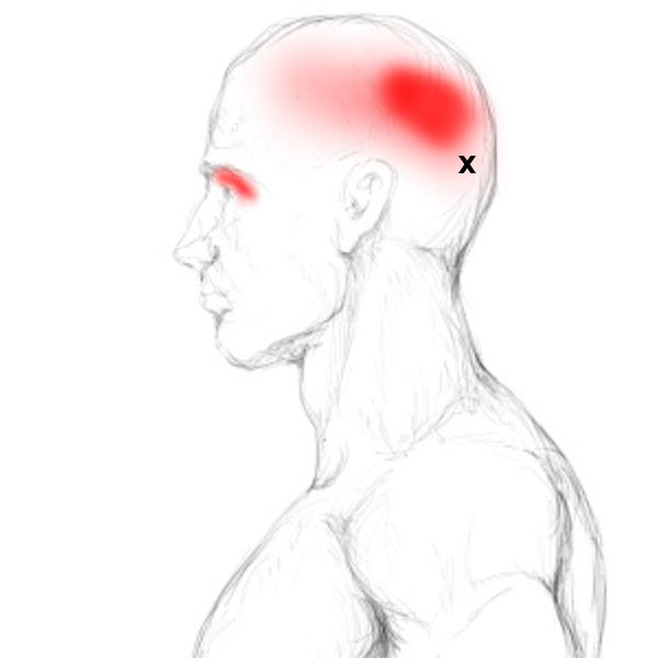 Frontalis & Occipitalis Schmerzen und Triggerpunkte selbst behandeln