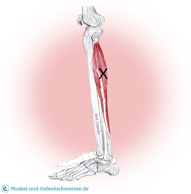 Peroneus longus, brevis und tertius Schmerzen und Triggerpunkte