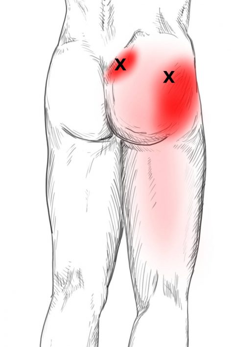 Tennisball piriformis triggerpunkte Ischias linkes