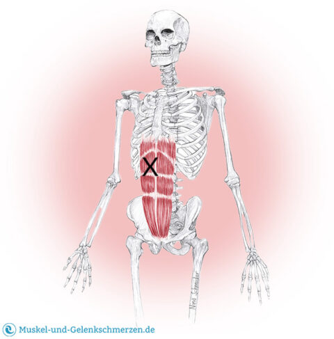 Rectus abdominis Schmerzen und Triggerpunkte selbst behandeln Rectus abdominis Schmerzen und Triggerpunkte selbst behandeln