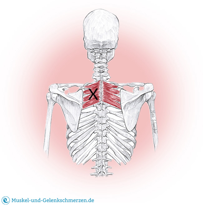 Serratus posterior superior Schmerzen und Triggerpunkte selbst behandeln