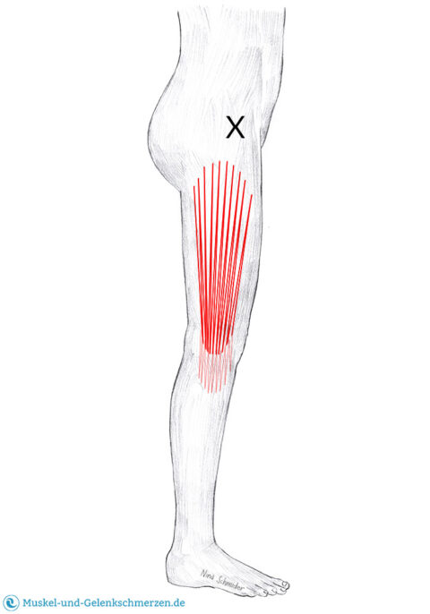Tensor fasciae latae Schmerzen und Triggerpunkte selbst behandeln