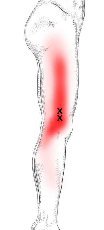 Quadriceps Femoris Schmerzen Triggerpunkte Selbst Behandeln