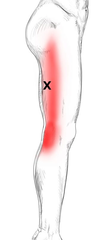 Quadriceps Femoris Schmerzen Triggerpunkte Selbst Behandeln