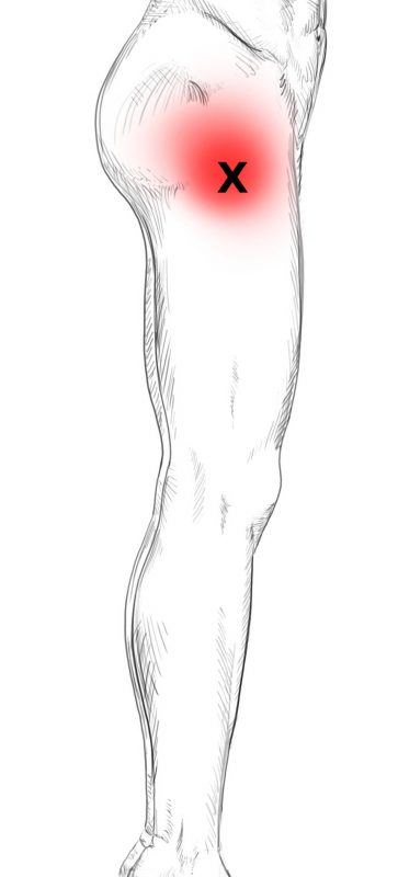 Quadriceps Femoris Schmerzen Triggerpunkte Selbst Behandeln