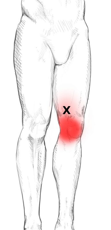 Quadriceps Femoris Schmerzen Triggerpunkte Selbst Behandeln
